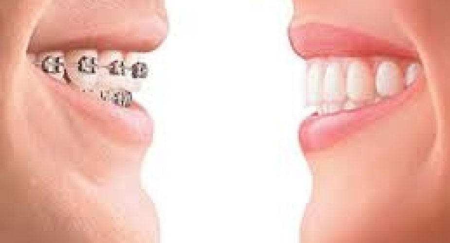 Ortodonti Diş Estetiği