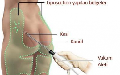 Liposuction Nedir?