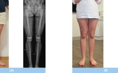 Çarpık Bacak Problemi Yalnızca Bir Operasyonla Düzeltilebilir mi?