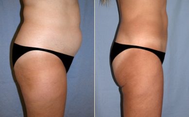 Liposuction nedir?