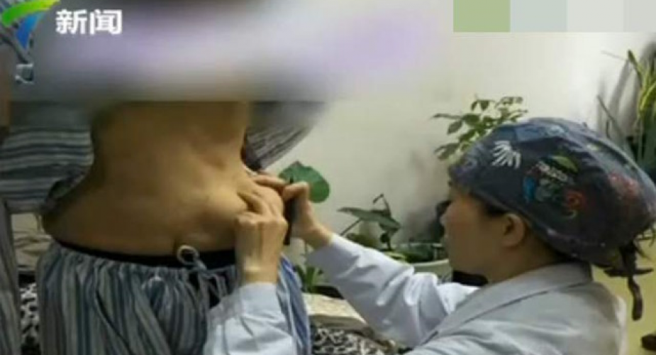 Enjeksiyonla Meme Operasyonu Yaptıran Kadının Göğüsleri Karnına Düştü