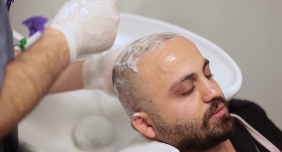 Saç ekimi sonrası neden ilk yıkama önemli ?